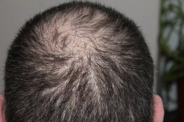 Lee más sobre el artículo Calvicie (Alopecia)